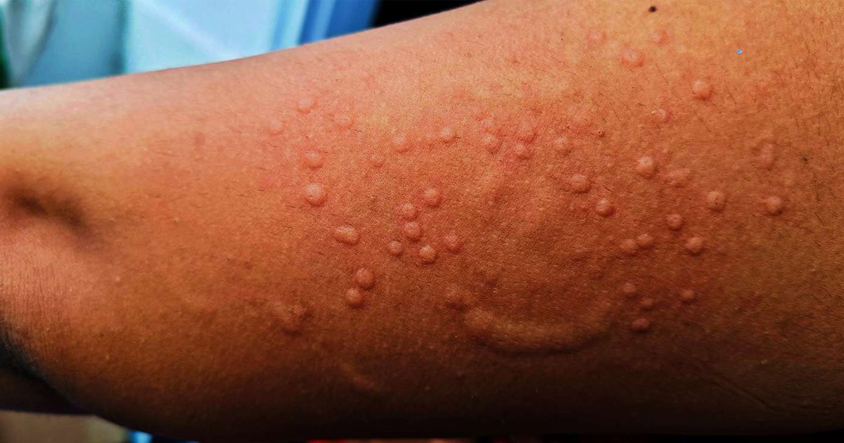 Mpox